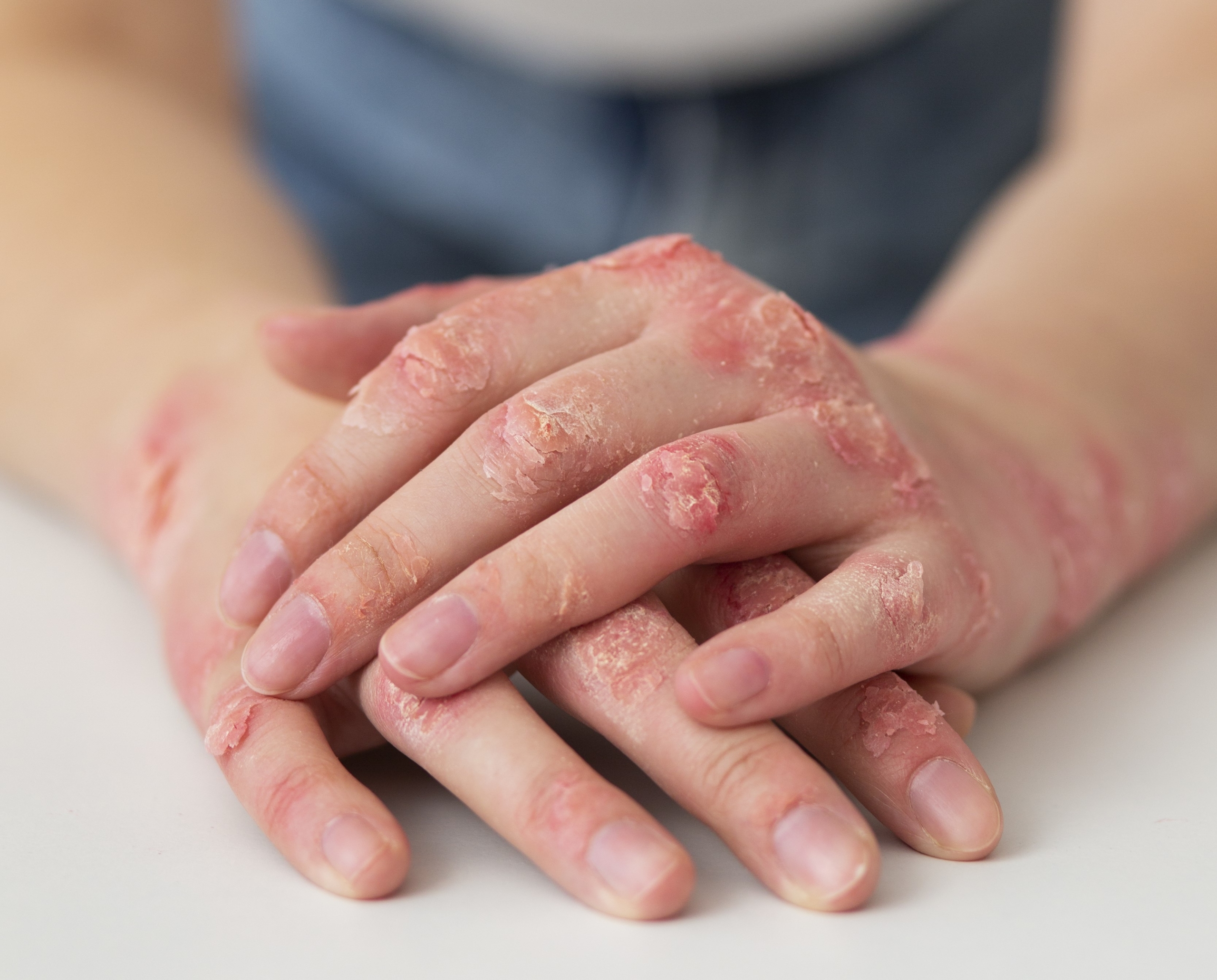 hands-patient-suffering-from-psoriasis
